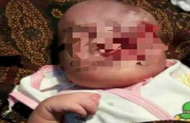 Foto: Kondisi Bayi Yang Lahir Dengan Kondisi Cacat Fisik di Wajahnya