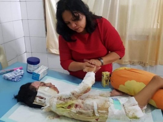 Foto: Korban kekerasan ibu kandungnya saat menjalani perawatan medis (satubmr.com)
