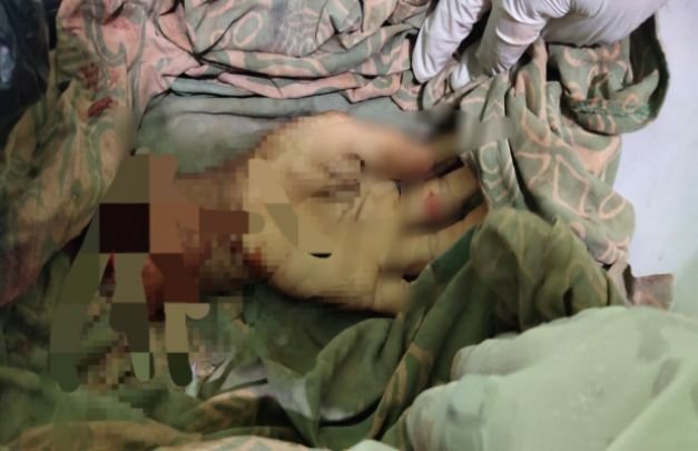 Foto: potobgan tangan korban pembacokan di sumenep