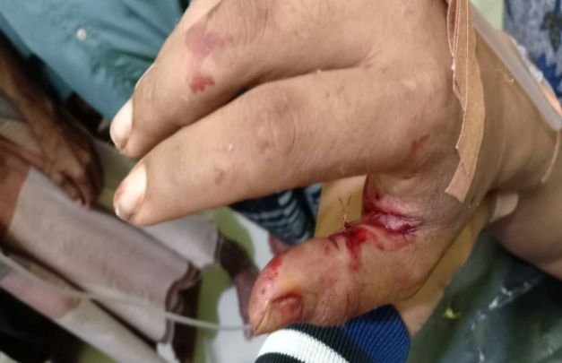 Foto: Asmad, korban pembacokan di Desa Tambaagung Kecamatan Ambunten Sumenep.